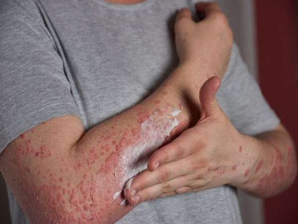 Autoimmune Disease Treatment Market Sales and Revenue Report by 2030 | Johnson & Johnson, Abbott Laboratories