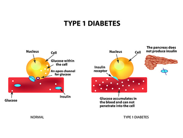 Type 1 Diabetes Market Set for Explosive Growth to Reach US$ 24.36 Bn by 2031:Novartis, Novo Nordisk, Sanofi, Novartis