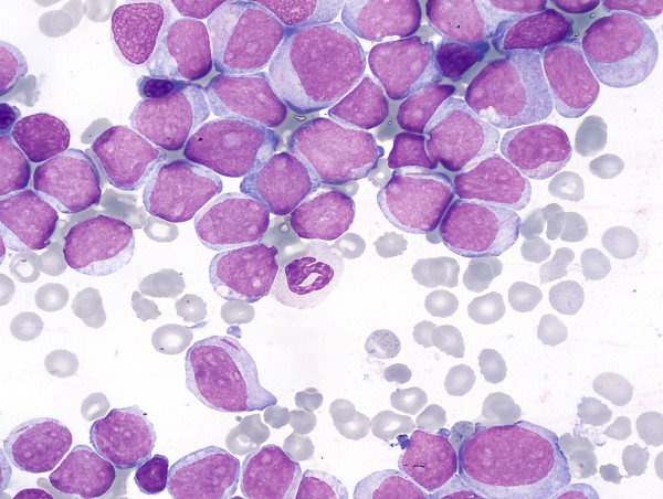  Acute Myeloid Leukemia AML Market Sector Market Trends, Size, and Growth Report 2024 - 2031 