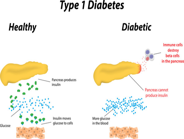Type 1 Diabetes Market Set to Eyewitness Substantial Growth by 2024-2031: Sanofi, Wockhardt Ltd., Ypsomed AG, Novartis