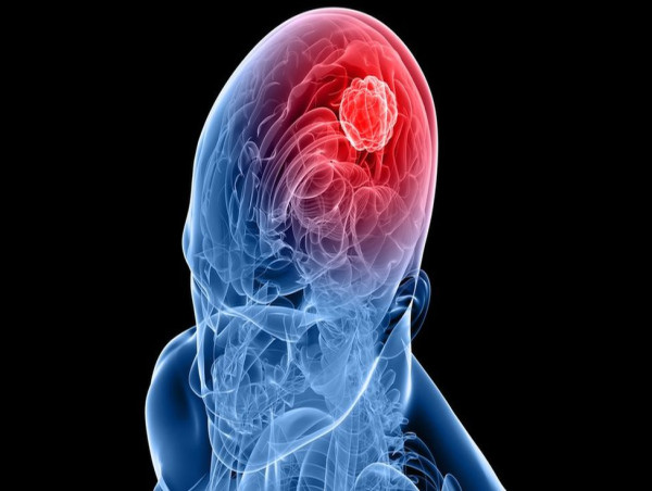 Glioblastoma Market Industry Size, Market Share, and Growth Prospects Report 2024 - 2031