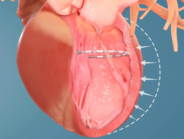 Cardiac Restoration Systems Market Industry Size, Market Share, and Growth Prospects Report 2024 - 2031