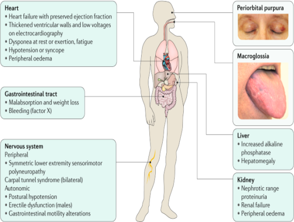  AL Amyloidosis Diagnostic Market Industry Overview, Market Share, and Growth Prospects Report 2024 - 2031 