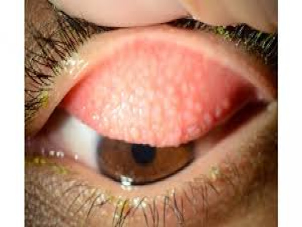  Giant Papillary Conjunctivitis Market Thrives Globally with Strong Prospects by 2031 | Bausch & Lomb , CooperVision, Inc 