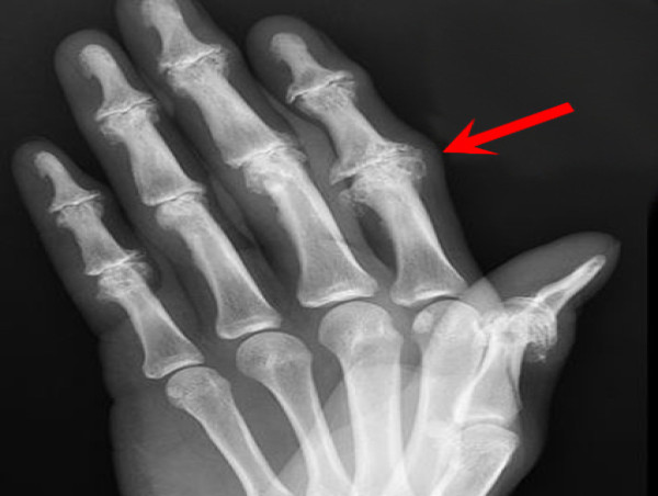  Erosive Hand Osteoarthritis Market Remarkable Growth Projected by 2031, Explore By Celgene Corporation, Amgen 