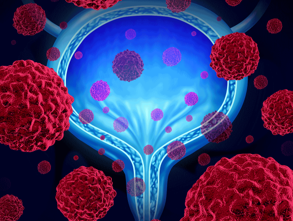  Non Muscle Invasive Bladder Cancer Market Breaking New Ground | Merck & Co., Inc., Ferring Pharmaceuticals, Pfizer Inc. 