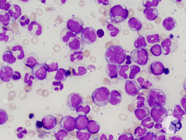 BK Virus Infection Market Rising Awareness and Innovations Drive Growth | AlloVir, Amplyx Pharmaceuticals