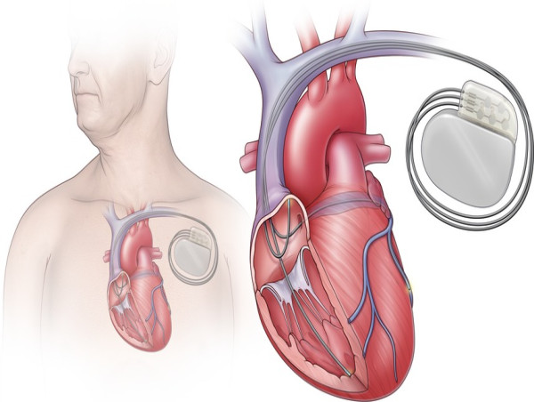 Cardiac Resynchronization Therapy Market: Growth Driven by Rising Heart Failure Cases | Corporation, and MEDICO S.p.A