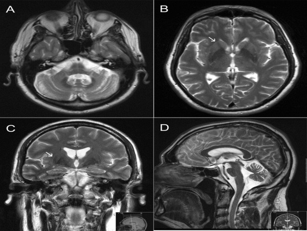  Emerging Insights: Market Trends in Multiple System Atrophy (MSA) Market | Acadia Pharmaceuticals Inc 