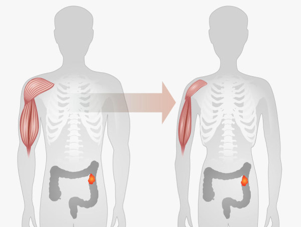 Cancer Cachexia Market Size Expansion to USD 4.03 Billion by 2032, Driven by 5% CAGR - Report By | VMR