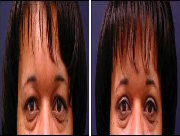  Dr. Sam Speron Shows the Way with his Modern Blepharoplasty Surgery 