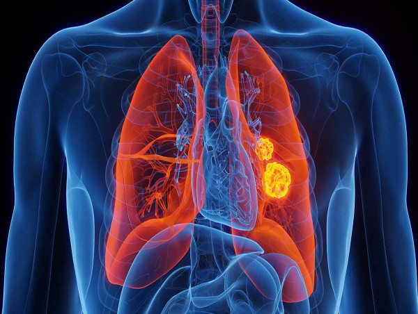  Lung Cancer Surgery Market Size Expected to Hit USD 8.34 Billion by 2032, Expanding at a 4.1% CAGR: VMR 