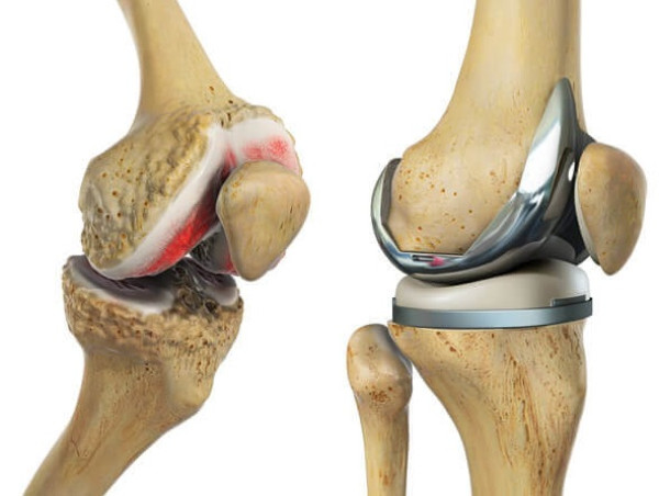  Knee Replacement Market Size Expansion to USD 14.63 Billion by 2032, Driven by 4.52% CAGR - Report By | VMR 