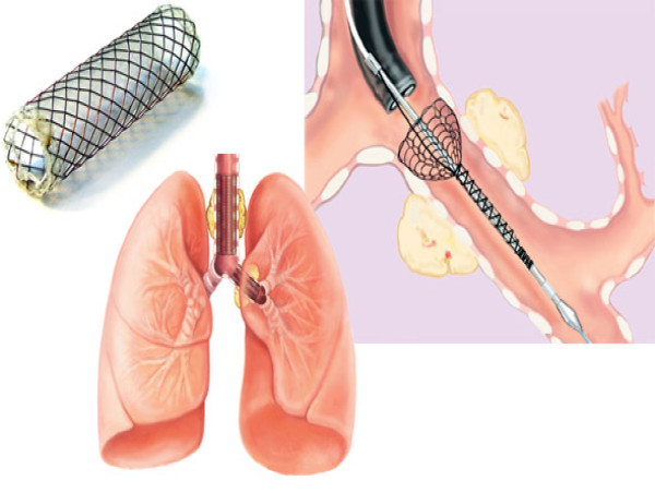  Lung Stent Market Size to be Worth USD 345 Million by 2032, with a Projected CAGR of 6.9% 