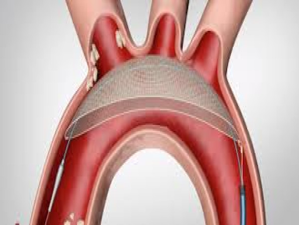  Embolic Protection Devices Market Size Expected to Hit USD 1250 Million by 2032, Expanding at a 8.5% CAGR: VMR 