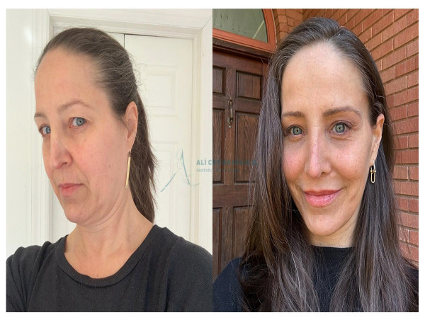  ACEsthetic Clinic by Dr. Ali Cetinkaya Announces Advancements in Aesthetic Surgery Techniques 
