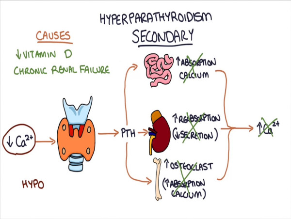  Hyperparathyroidism Treatment Market Expands with New Therapeutic Advancements and Forecast 2024 - 2031 