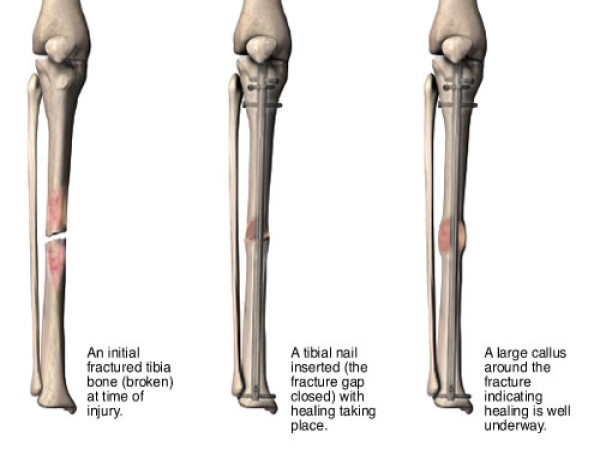  Intramedullary Nail Market CAGR of 7.6% Trends and Growth Analysis By 2024 to 2031 | Stryker, B. Braun SE, Zimmer Biomet 