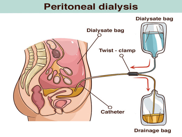  Peritoneal Dialysis Equipment Market CAGR 6% : Opportunities in Emerging Markets and Global Expansion from 2024 to 2031 