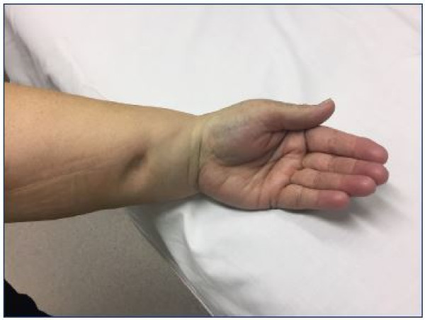 Lymphedema Diagnostics Market to Reach USD 70.7 Million by 2034, Growing at a CAGR of 4.8% |Transparency Market Research 