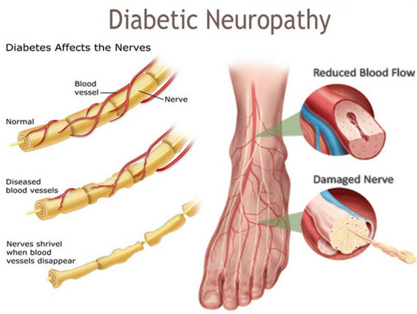  Diabetic Neuropathy Market Generated Opportunities, Future Scope 2024-2031 | Eli Lilly and Company, GlaxoSmithKline 