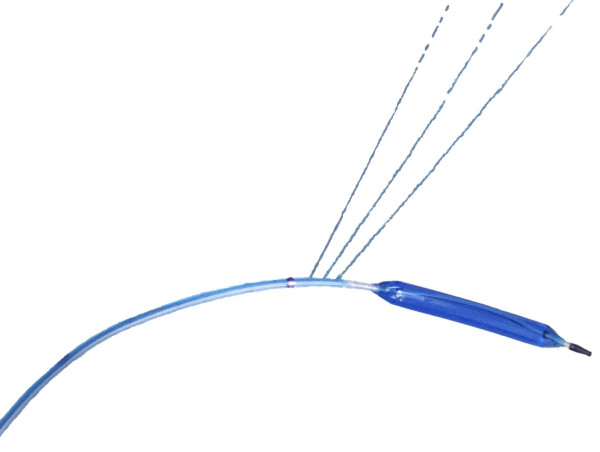  First US Commercial Case of the All’InCath™ Specialty PTA Catheter 