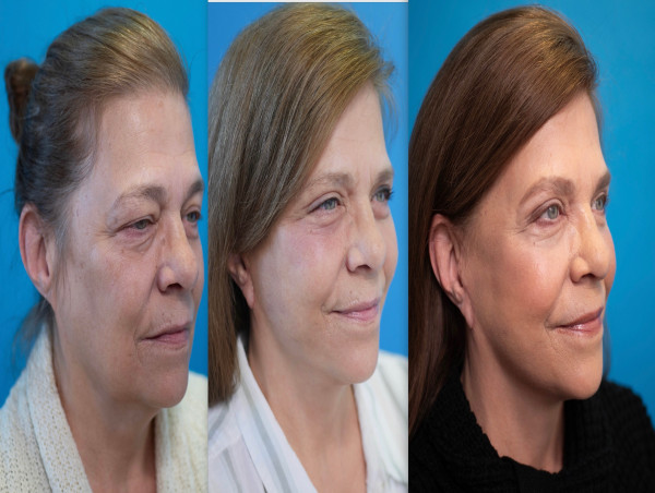  2025 Ushers In A New Era Of Undetectable Facelifts 