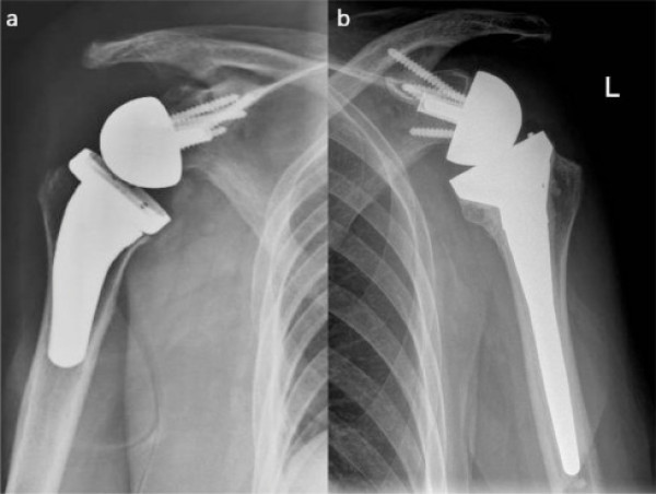  Shoulder Arthroplasty Market Research Report by focusing on Top Companies like Zimmer Biomet, Johnson & Johnson, Arthrex 