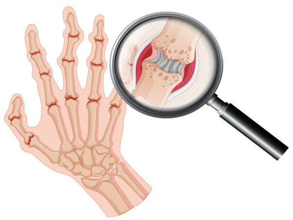  Rheumatoid Arthritis Therapeutics Market New Treatments on the Horizon for Patients | Forecast To 2025 - 2034 