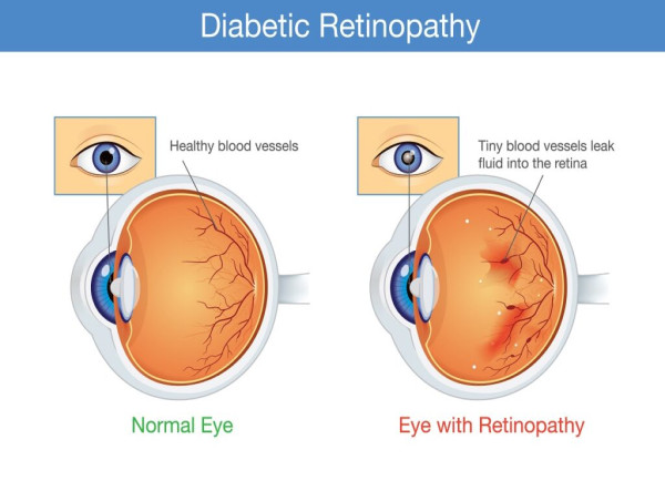  Diabetic Retinopathy Market Set to Witness Significant Growth by 2025-2032: Roche Holding AG, Allergan PLC, Novartis AG 