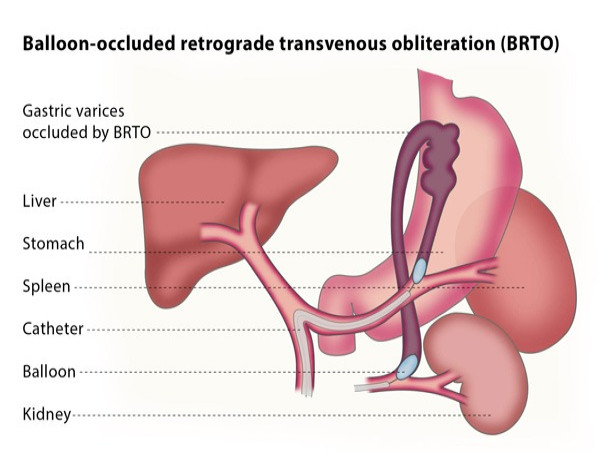  Kidney Balloon Market Size to Reach USD 2.50 billion by 2032 by Growing at 5.2% CAGR 