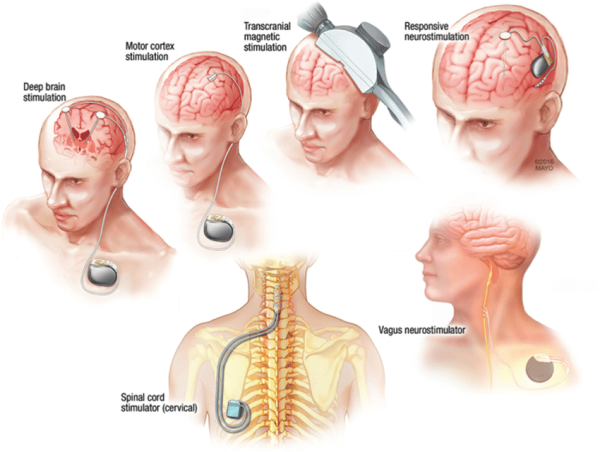  Neurostimulation Devices Market Size to Reach USD 16.6 billion 2034 Growing at 12.5% CAGR Exactitude Consultancy 