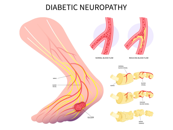  U.S. Diabetic Neuropathy Market to Witness Stunning Growth with Eli Lilly & Company, Johnson & Johnson Services, Pfizer 