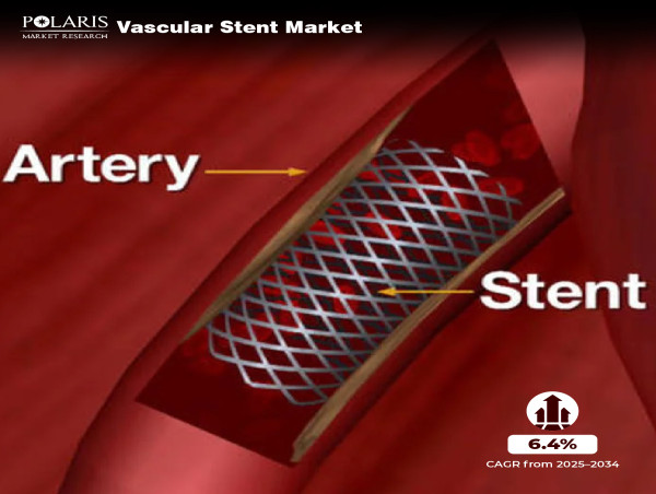  6.4% CAGR Growth Projected for Vascular Stent Market, Reaching $21.03 Billion by 2034 