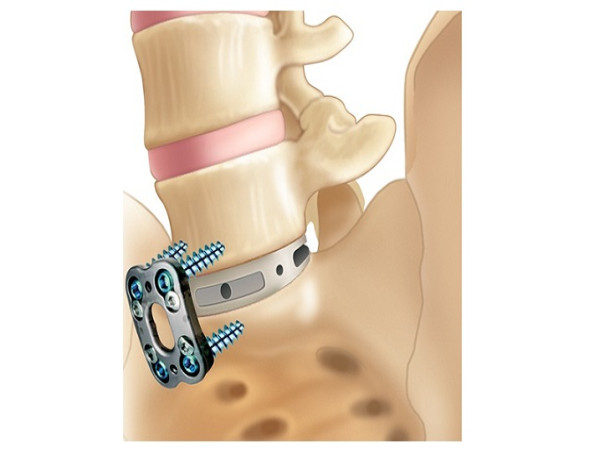  Spinal Fusion Devices Market Witnessing Rapid Expansion, Key Trends and Industry Analysis: Orthofix International N.V. 