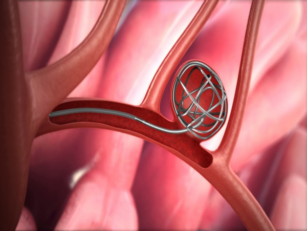  Neuroendovascular Coil Market Witnessing Rising Adoption | Key Players & Outlook 2032: Stryker, Codman, MicroVention 