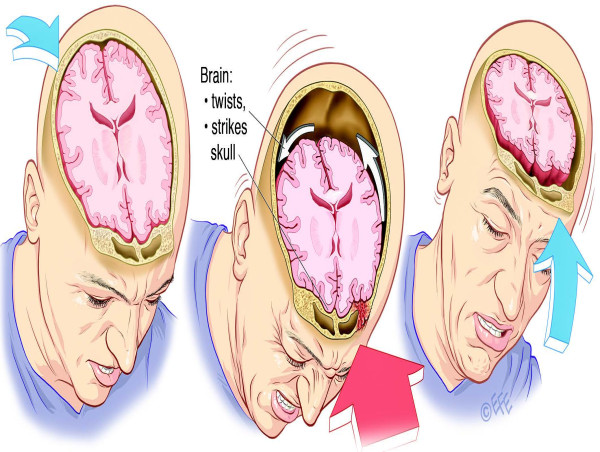  Concussion Market Projected To Witness Substantial Growth, 2025-2032: Abbott Laboratories, BrainScope Company Inc 