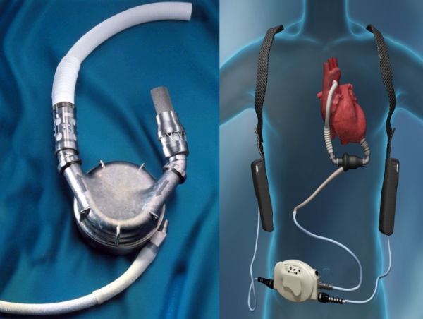 Cardiac Assist Devices Market Projected To Witness Substantial Growth, 2025-2032: MAQUET GmbH & Co., Berlin Heart GmbH