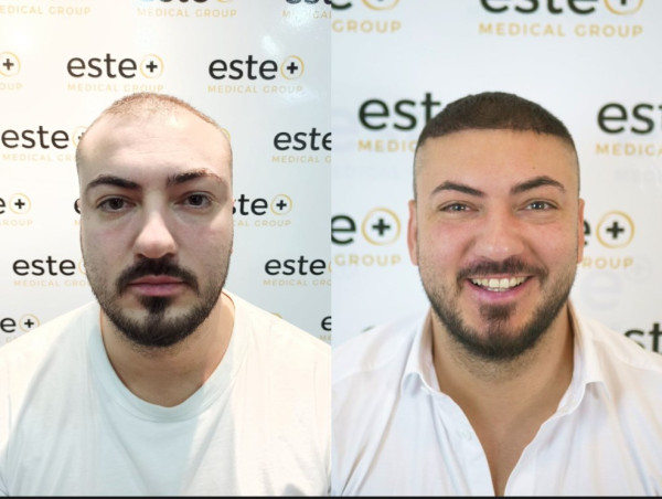  Este Medical Group Expands Glasgow Clinic to Meet Rising Demand for Hair Restoration 