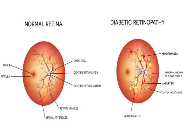  Diabetic Retinopathy Market Set to Witness Significant Growth by 2025-2032: Novartis AG, Bayer AG, Optos PLC, Canon Inc 