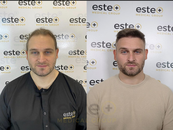  Este Medical Group Expands to Bristol, Offering Cutting-Edge Hair Loss Solutions for Men and Women 