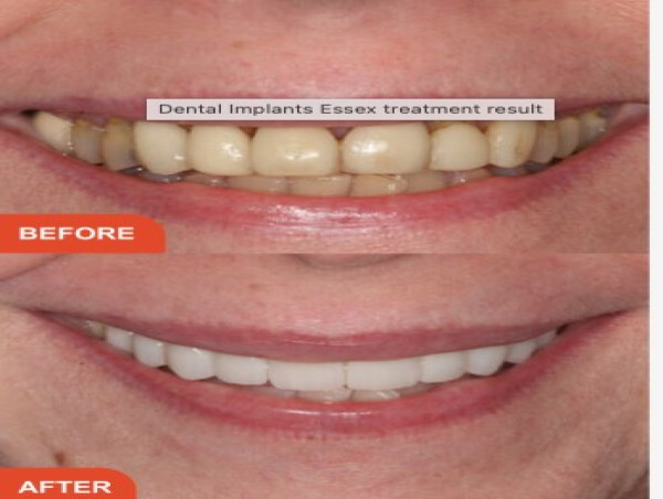  Perfect Smile Spa Unveils Next-Gen Composite Veneers for Instant Smile Transformations 