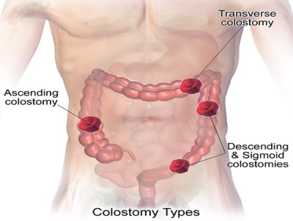  Ostomy Care Market Projected To Witness Substantial Growth, 2025-2032: 3M, Coloplast Corporation, ConvaTec, Alcare 
