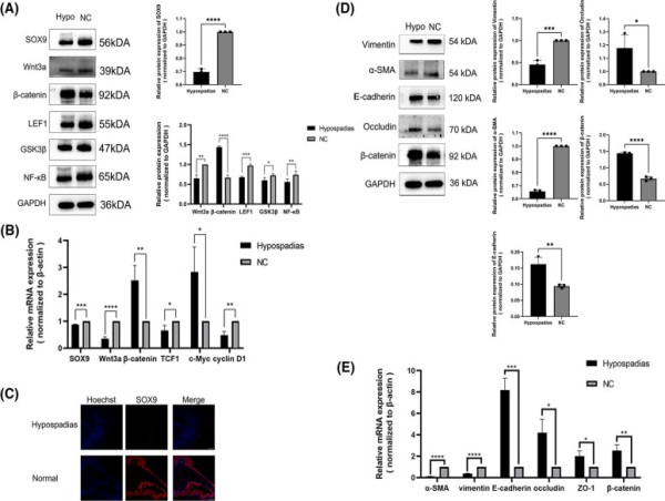  New insights into hypospadias: SOX9's role in urethral formation revealed 