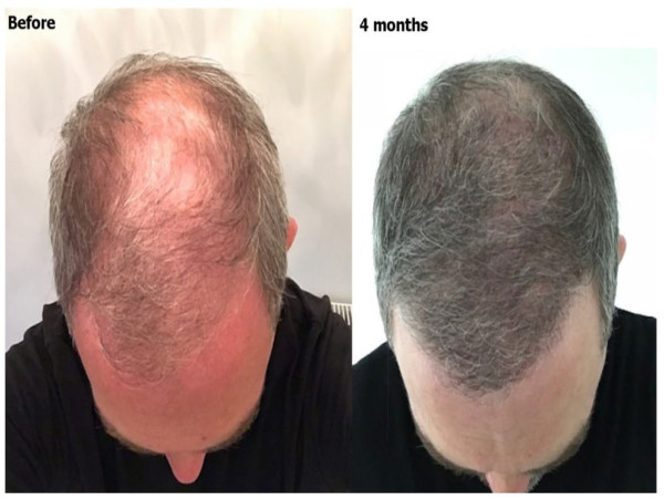 AlviArmani Patients Seeing Faster Results with PRP-Enhanced Hair Restoration Procedures