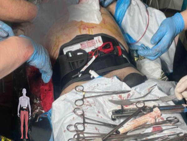 Once Considered Fatal, Traumatic Cardiac Arrest Now Being Shown to Be Survivable in Ukrainian War Case Series