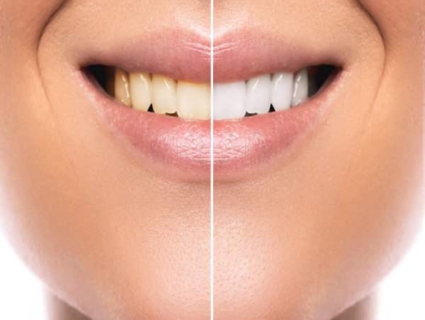  Comparing In-Office Teeth Whitening with Over-the-Counter Kits: What Sets Them Apart 