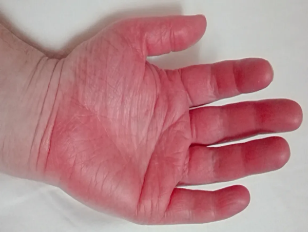  Erythromelalgia Treatment Market Forecasted to Reach USD 3.68 Billion by 2032, CAGR of 5.5% 