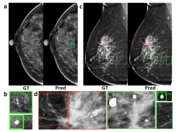 Artificial intelligence-based diagnosis of breast cancer by mammography microcalcification