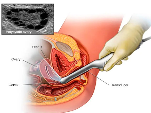 Polycystic Ovary Syndrome (PCOS) Treatment Market Size to Reach US$ 1,666.1 Mn by 2032, Reports Coherent Market Insights
